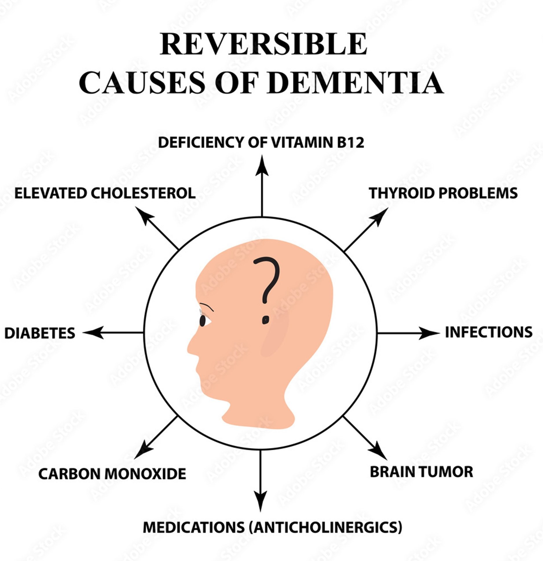Reversible Causes of Dementia_AdobeStock