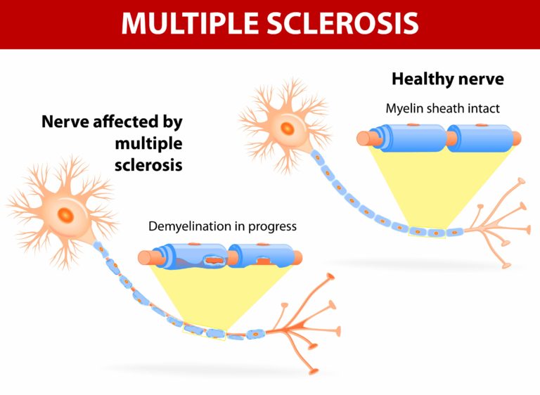 7 Strategies for Navigating Multiple Sclerosis (MS) with In-Home Care Services